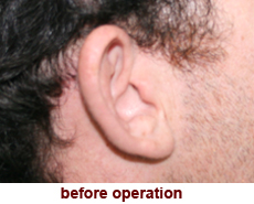 plastic-surgery-prominent-ear 